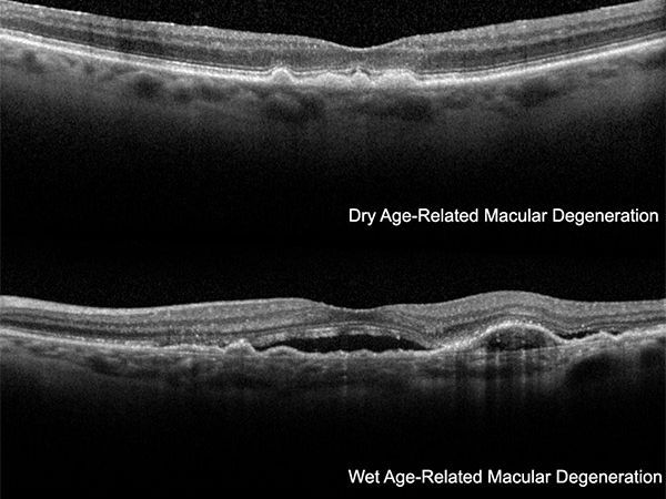 An image showcasing the Macular Degeneration package, provided by Vitreous Retina Macula Consultants of New York An image showcasing the Macular Degeneration package, provided by Vitreous Retina Macula Consultants of New York